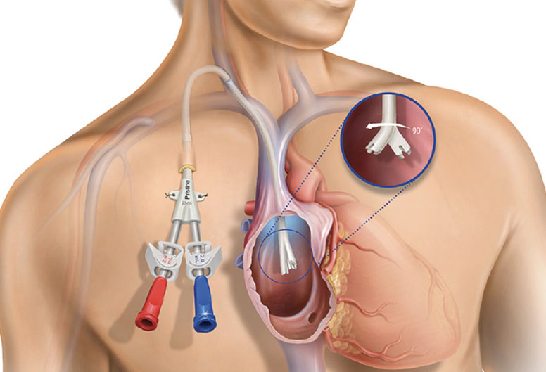 This image has an empty alt attribute; its file name is Interventional-Nephrology-Renal-Biopsy-Dialysis-Catheter-Temporary-Tunnelled-Catheters.jpg
